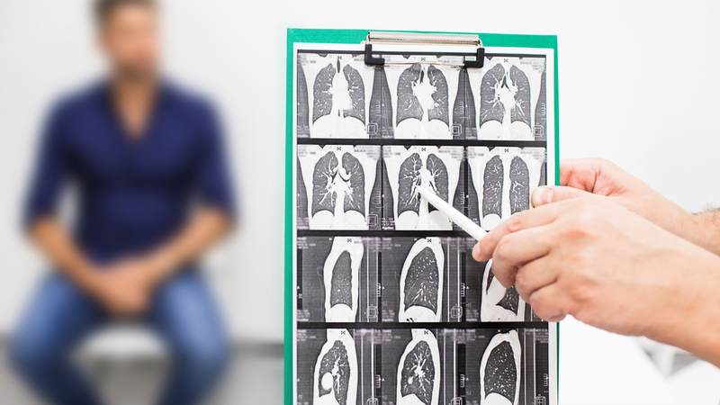 Xơ phổi 1/3 là gì​? Nguyên nhân, triệu chứng và chẩn đoán xơ phổi 1/3 1