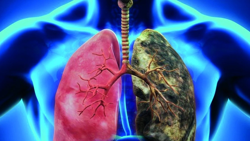 Xơ phổi có phải ung thư không? Hiểu đúng để điều trị hiệu quả 2