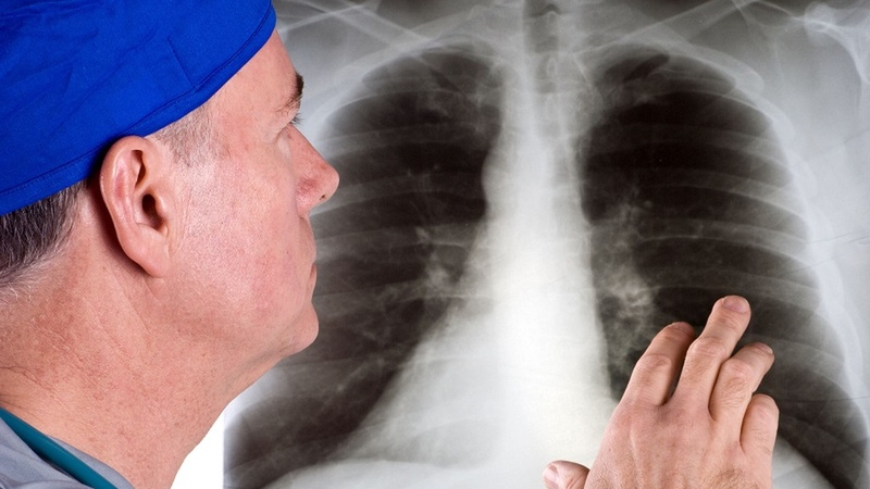 Xơ phổi có phải ung thư không? Hiểu đúng để điều trị hiệu quả 3