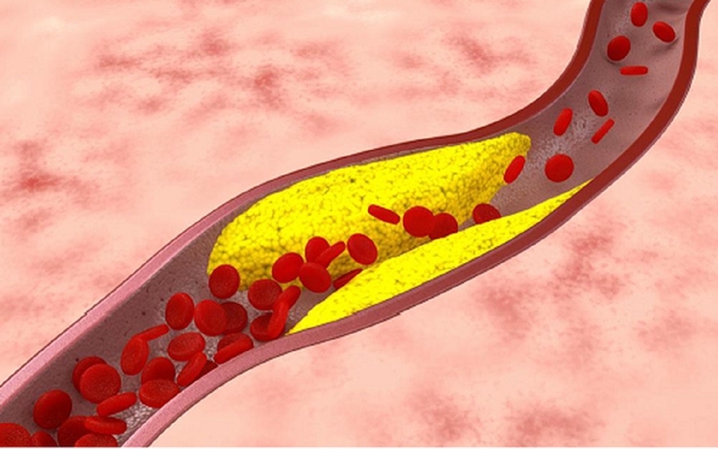 Xơ vữa động mạch vành là gì? Nguyên nhân gây xơ vữa động mạch vành? 2