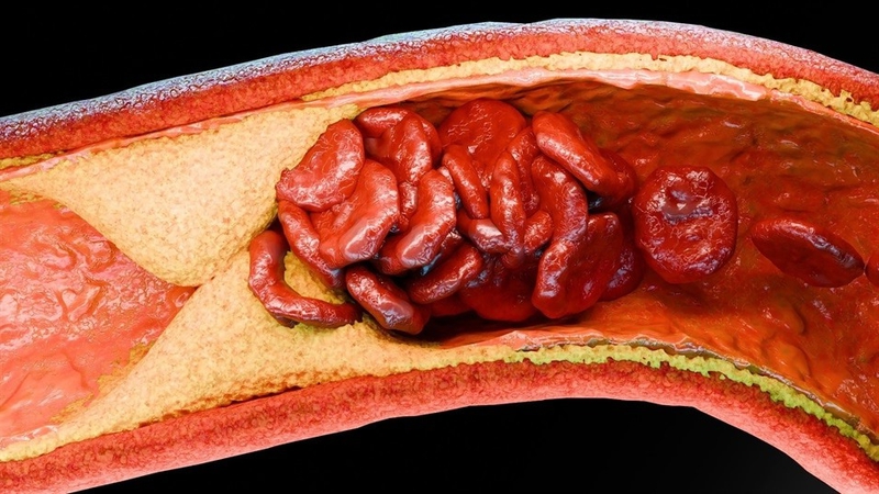 Xơ vữa động mạch vành phổ biến ngay cả ở người lớn có nguy cơ thấp với mức cholesterol bình thường 2