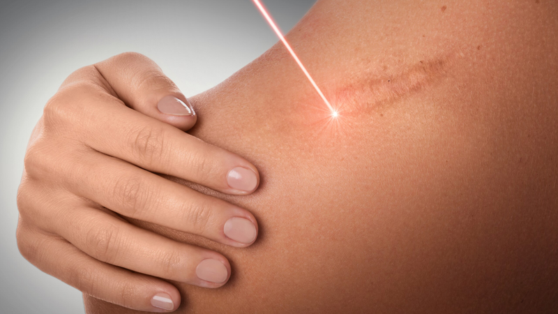 Xóa sẹo bằng laser bao nhiêu tiền? Tìm hiểu chi phí và lợi ích của phương pháp này 1