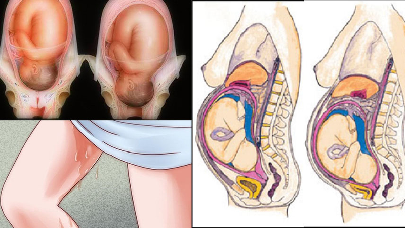 Xử trí tích cực giai đoạn 3 của cuộc chuyển dạ 1