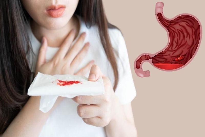 Xuất huyết dạ dày nôn ra máu có nguy hiểm không? 2