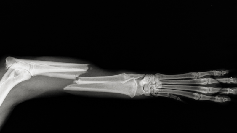 Xương cánh tay: Chi tiết giải phẫu và một số chấn thương thường gặp 2