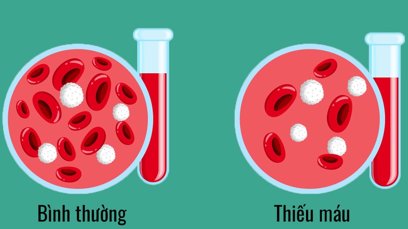 Bệnh xương hóa đá và những rủi ro tiềm ẩn 3