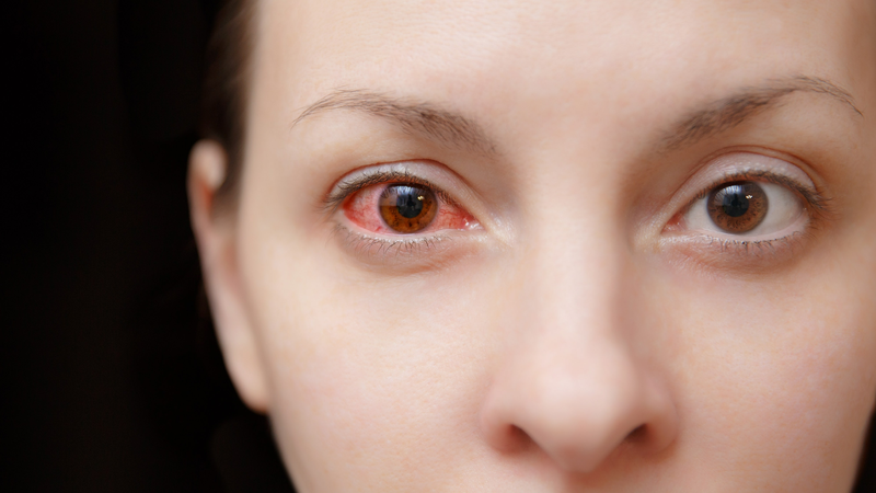 Những dấu hiệu bệnh đau mắt đỏ bạn không nên bỏ qua1