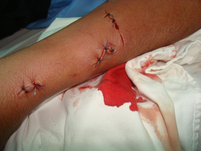 Hướng dẫn các bước sơ cứu cầm máu cho từng loại vết thương 1