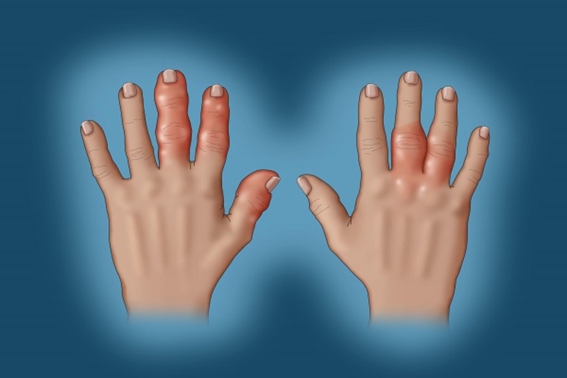 Hướng dẫn các cách giảm đau do viêm khớp vảy nến không phải ai cũng biết 1