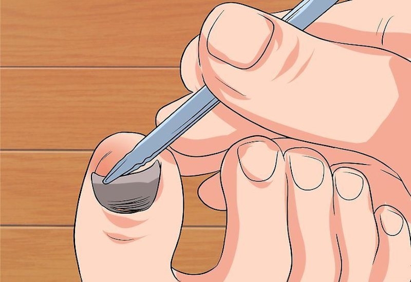 Làm sạch phần vết thương ngay sau khi bị bật móng