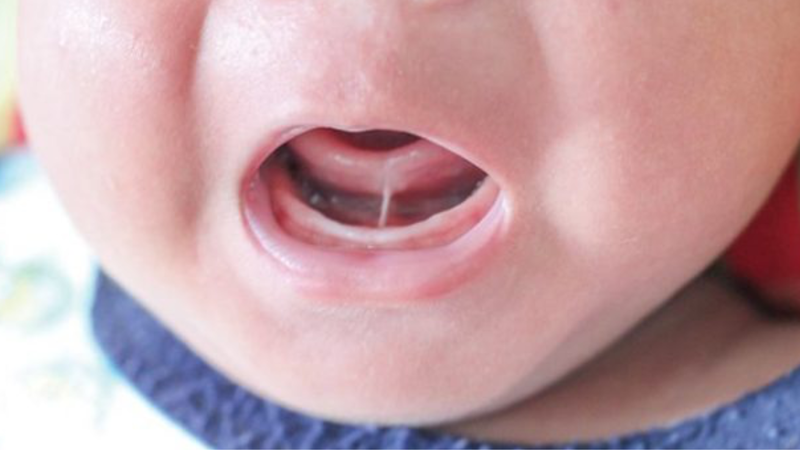 Hướng dẫn cách chăm sóc sau khi cắt thắng lưỡi cho bé 1