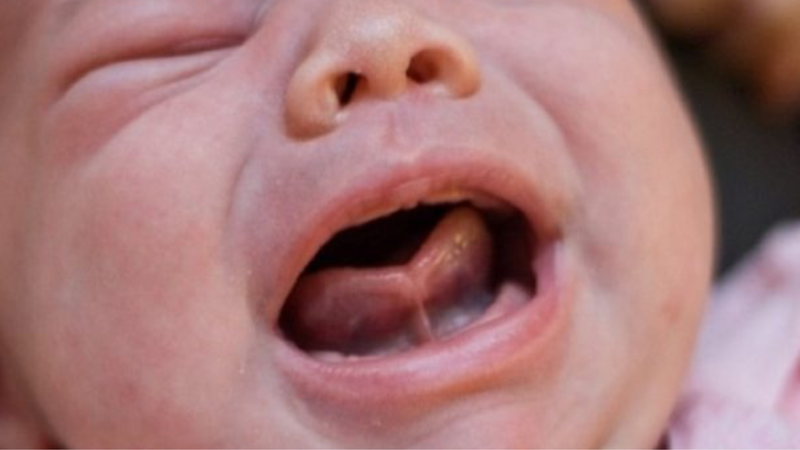 Hướng dẫn cách chăm sóc sau khi cắt thắng lưỡi cho bé 2