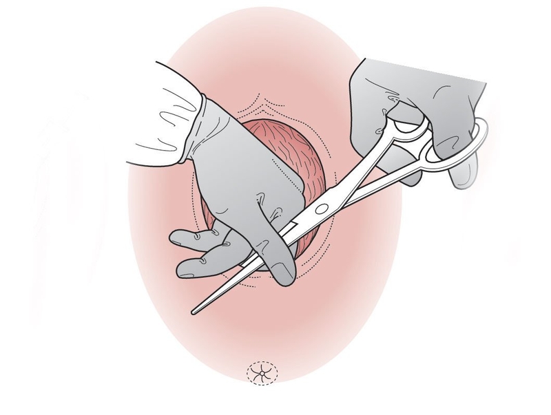 Hướng dẫn cách chăm sóc vết khâu tầng sinh môn tại nhà tránh viêm nhiễm 01