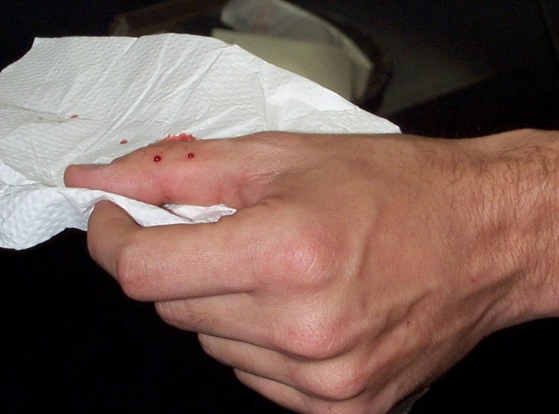 Hướng dẫn cách sơ cứu khi bị rắn cắn