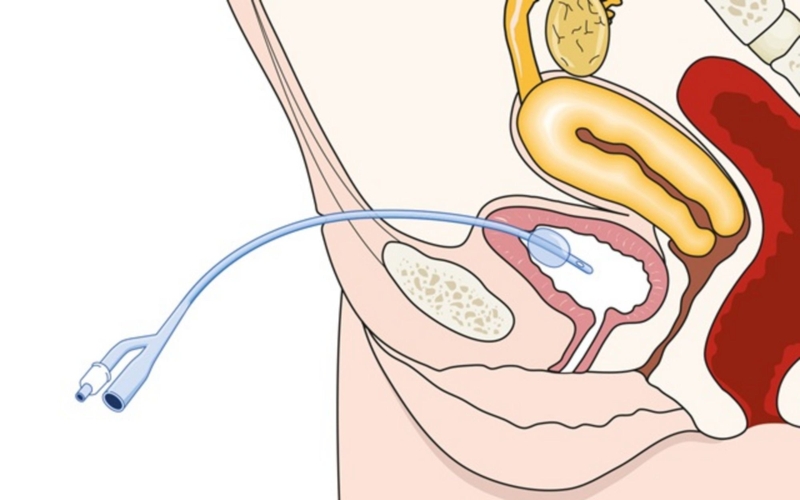 Hướng dẫn cách đặt ống thông tiểu nữ giới có gì khác biệt? -2