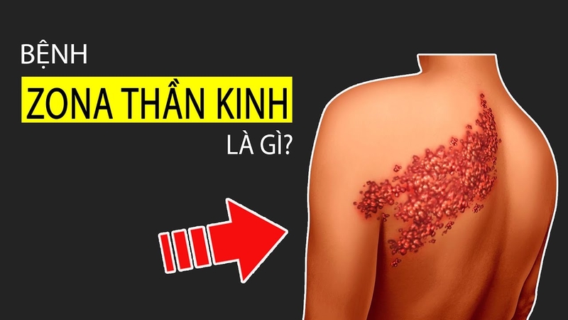 Zona thần kinh là một loại bệnh da liễu