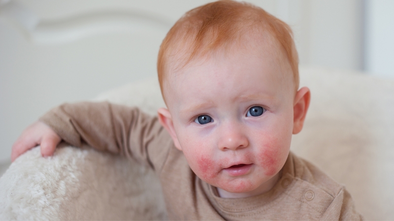 Top những cách làm sạch da cho trẻ bị viêm da cơ địa 1