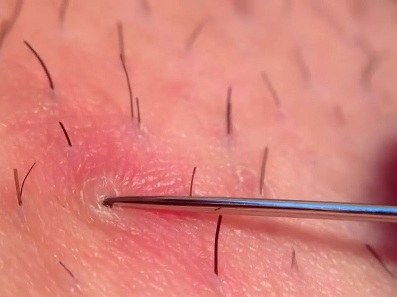 Hướng dẫn cách lấy lông mọc ngược hiệu quả và an toàn 2