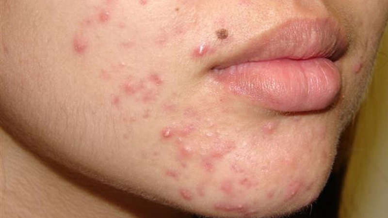 Hướng dẫn cách nặn mụn bọc không đầu hợp vệ sinh 1