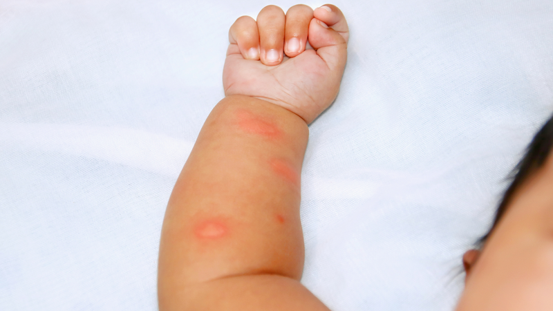 Hướng dẫn cách phòng chống sốt xuất huyết cho trẻ không phải ai cũng biết 2