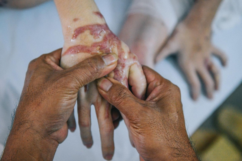 Axit H2SO4 có khả năng gây bỏng cho cơ thể người vì nó phản ứng với protein ở da, tóc, móng chân, móng tay