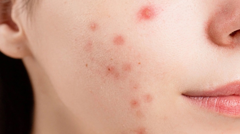 Hướng dẫn cách sử dụng bột quế và mật ong trị mụn hiệu quả 1