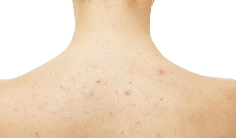 Cách trị viêm nang lông bằng mỡ trăn1