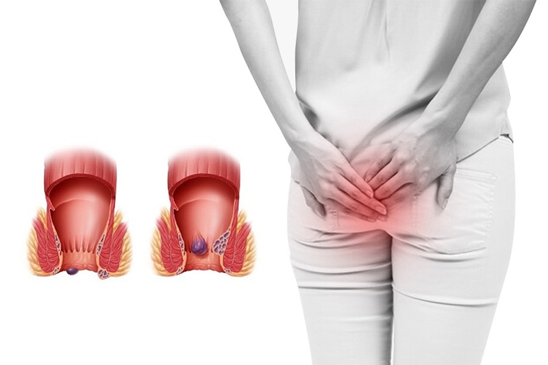 Hướng dẫn cách vệ sinh hậu môn chuẩn xác, khoa học 2