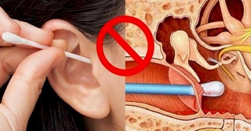 Hướng dẫn cách vệ sinh tai khi bị thủng màng nhĩ tại nhà 2