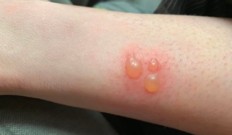 Hướng dẫn cách xử lý khi bị bỏng hiệu quả ngay tại nhà 1