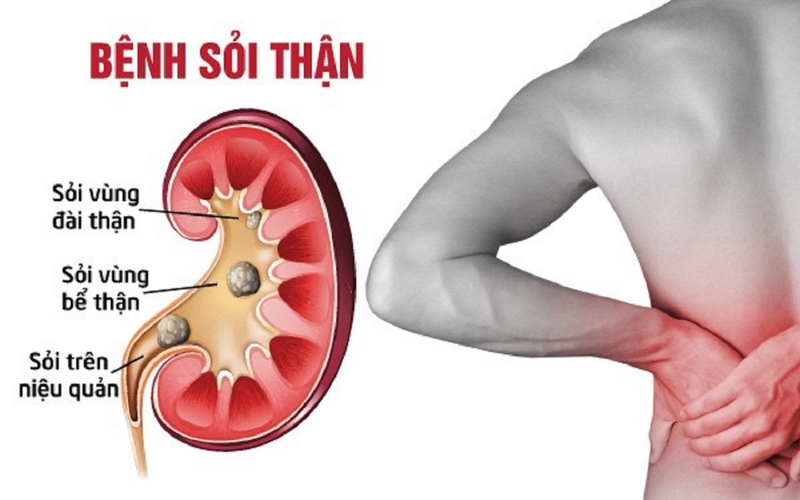 Rau ngót là loại thực vật phổ biến thường xuất hiện trong mỗi bữa ăn của gia đình, đồng thời có khả năng hỗ trợ điều trị bệnh sỏi thận