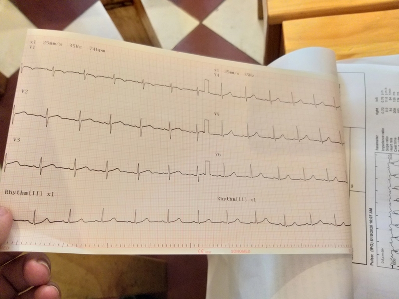 Hướng dẫn đọc kết quả điện não đồ và cách kiểm tra từ A đến Z 3