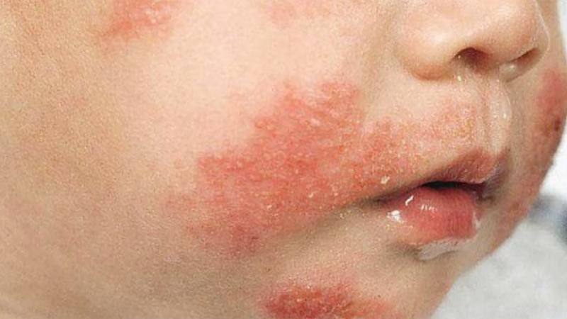 Hướng dẫn mẹ cách chăm sóc trẻ bị dị ứng đạm sữa bò 1