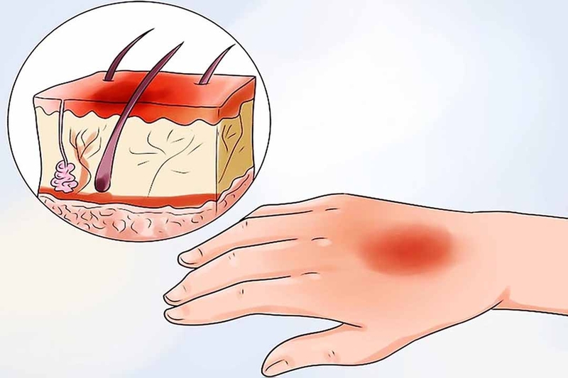 Hướng dẫn mẹ chăm sóc khi con bị bỏng 2