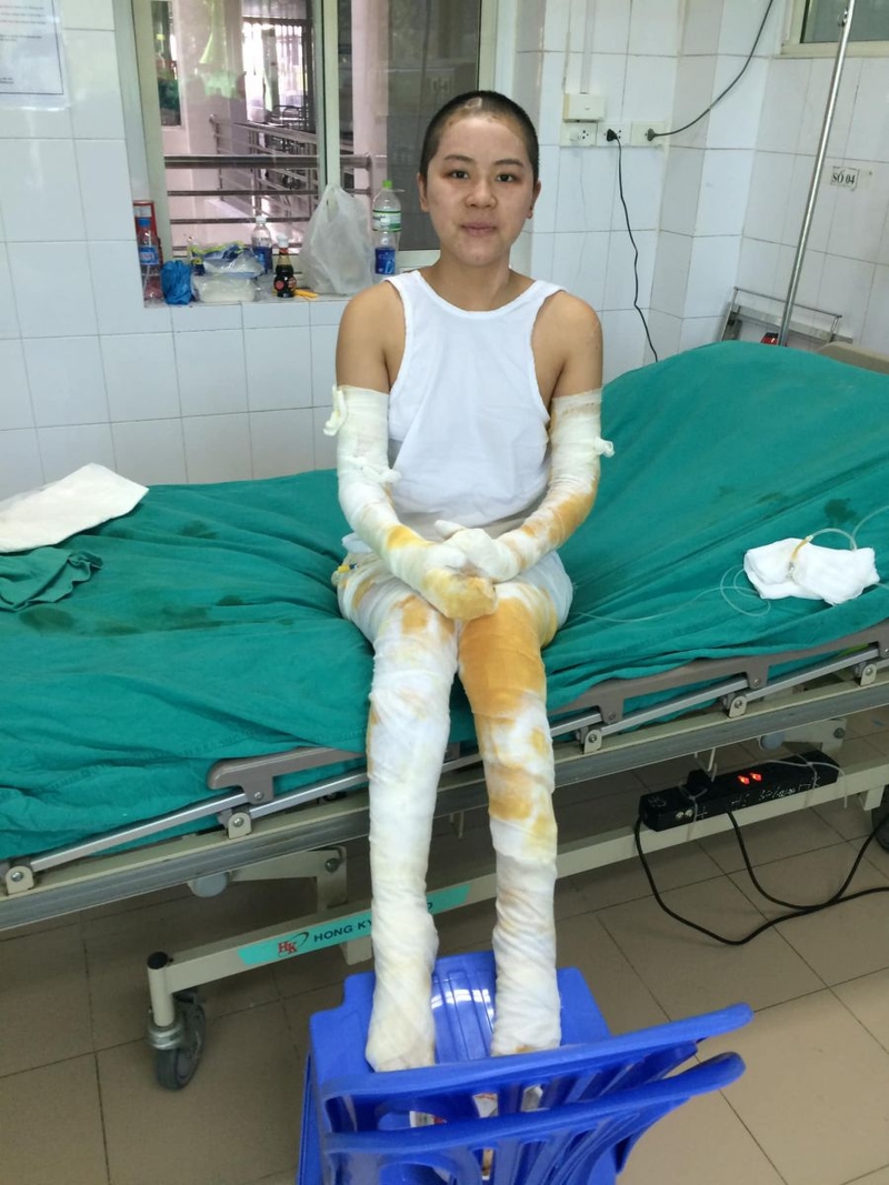 Hướng dẫn mẹ chăm sóc khi con bị bỏng 3