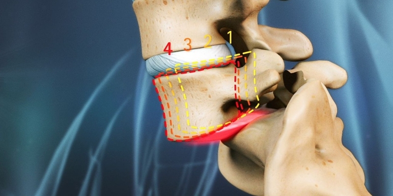 Hướng dẫn một số bài tập chữa trượt đốt sống lưng an toàn và hiệu quả 1