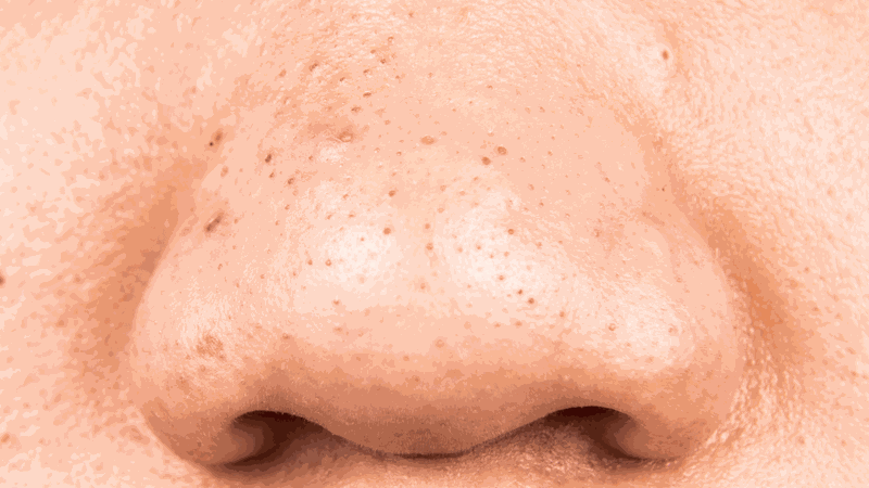 Hướng dẫn nặn mụn đầu đen ở mũi đúng cách tại nhà 1