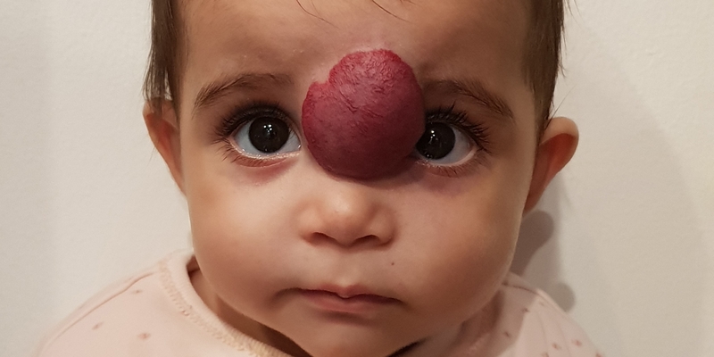 Hướng dẫn phân biệt bướu máu và bướu huyết thanh 4