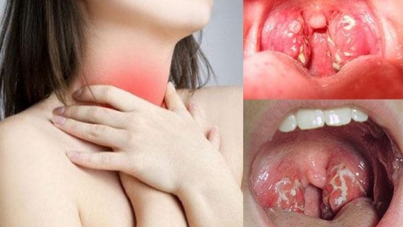 Hướng dẫn phân biệt viêm họng và viêm amidan 1