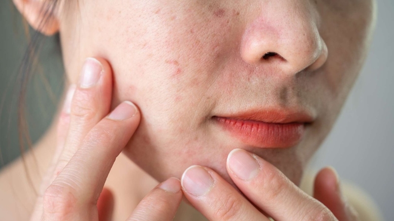 Hướng dẫn skincare cho da bị kích ứng đúng cách, hiệu quả 4