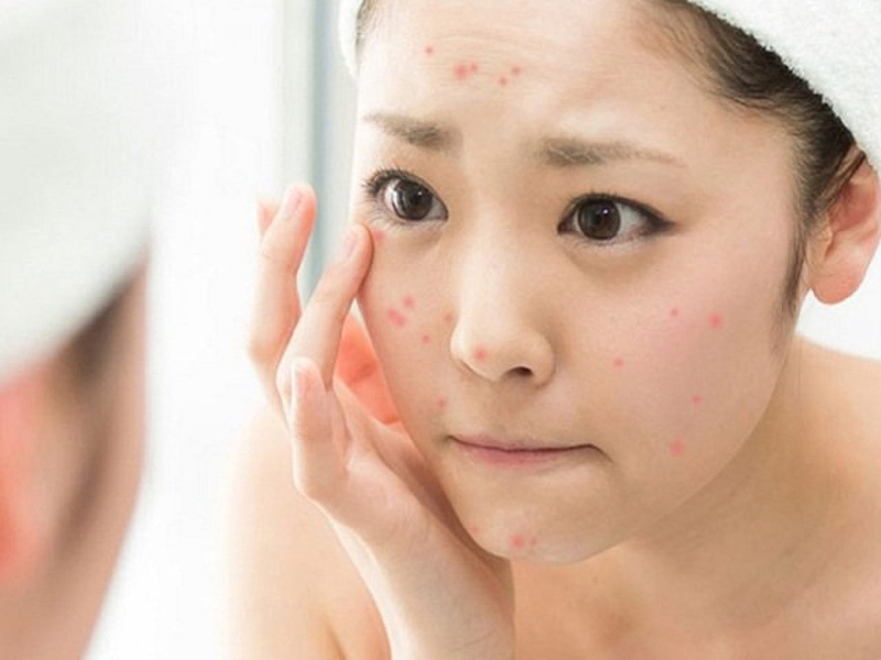 huong-dan-skincare-sau-khi-nan-mun-an-toan-cho-moi-loai-da2.jpg