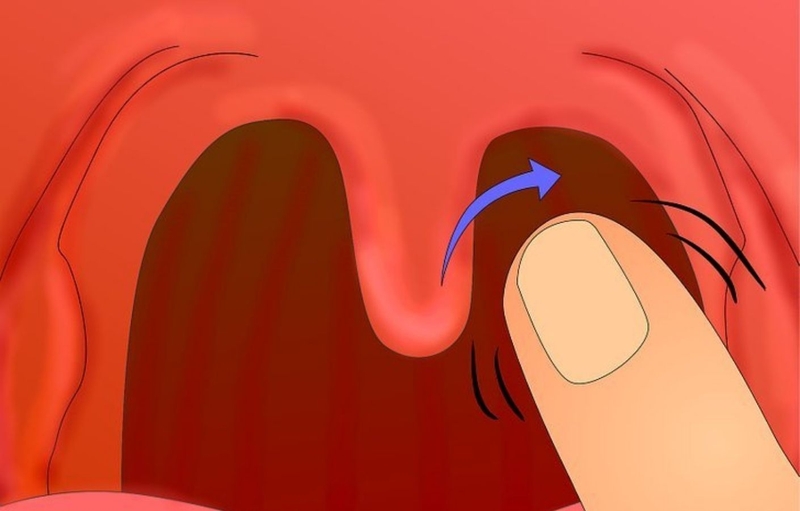 Hướng dẫn sơ cứu dị ứng hải sản 2