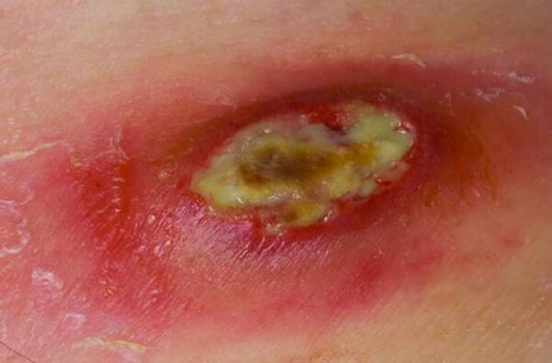 Sơ cứu vết thương hở đúng cách 5