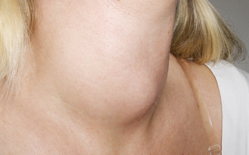 Hướng dẫn sử dụng lá sộp trị bướu cổ đơn giản tại nhà