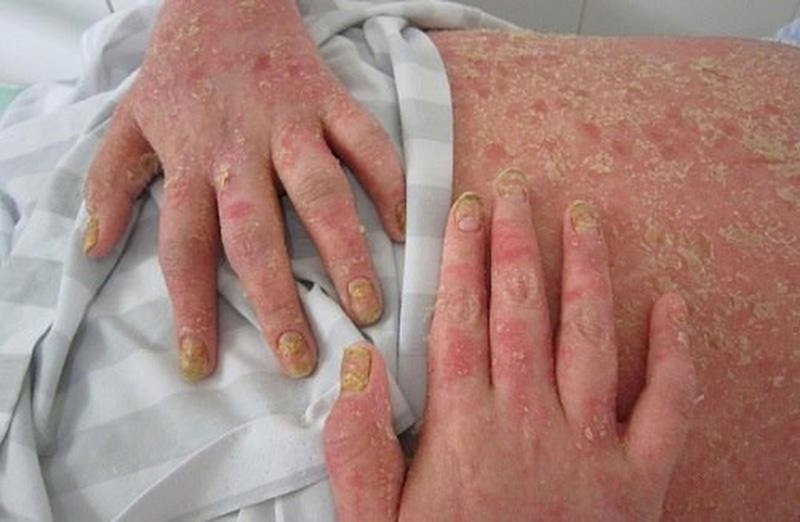 Hướng dẫn theo dõi bệnh viêm khớp vảy nến đúng quy trình bạn cần biết 2