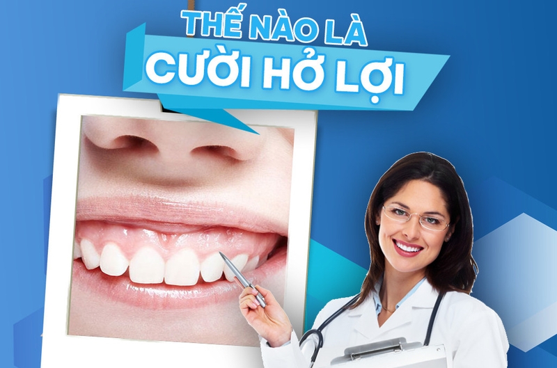 Hướng điều trị cười hở lợi và những lưu ý khi điều trị cười hở lợi 1