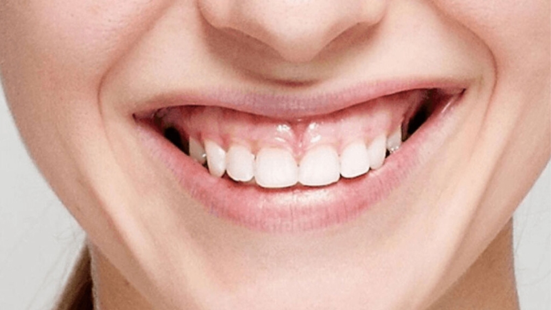 Hướng điều trị cười hở lợi và những lưu ý khi điều trị cười hở lợi 2