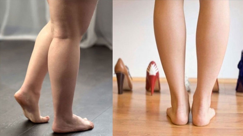 Những điều cần biết trước khi thực hiện hút mỡ bắp chân 2