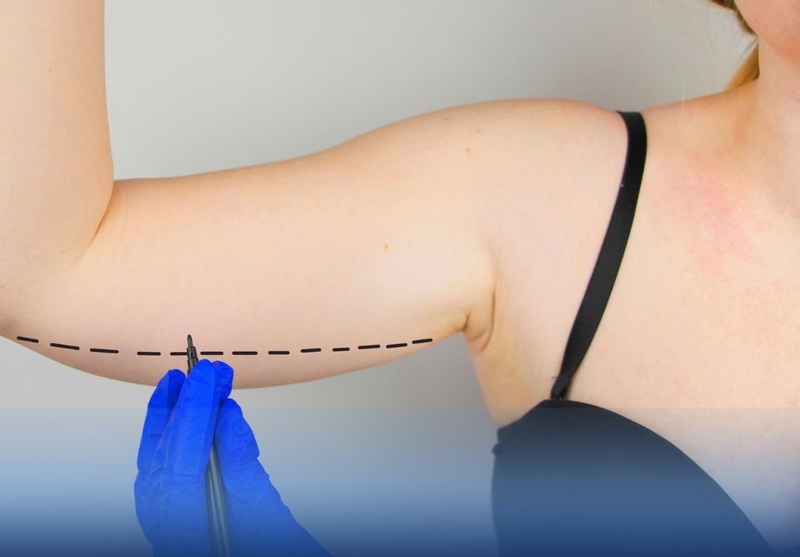 Hút mỡ bắp tay có nguy hiểm không?1