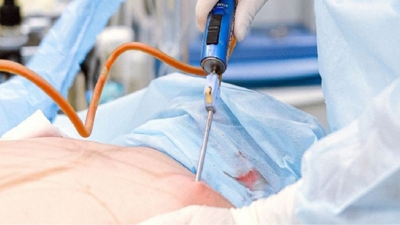 Hút mỡ nách và những điều cần biết về phương pháp này 2